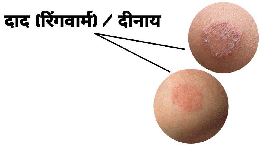 दाद (रिंगवार्म) क्या होता है? | What is RingWorm in Hindi?