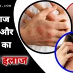 दाद खाज खुजली और दिनाय की बेस्ट दवा का नाम | Daad khaj khujli or Dinay ki Dawa