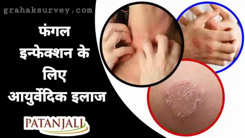 पतंजलि-आयुर्वेदिक-मेडिसिन-फॉर-फंगल-इन्फेक्शन